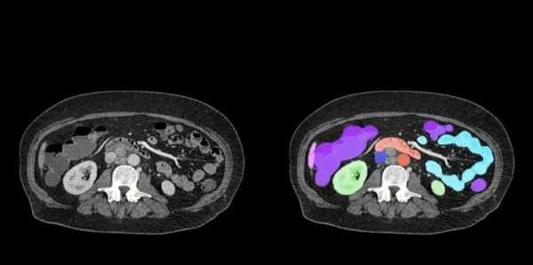 johns hopkins abdominatlas